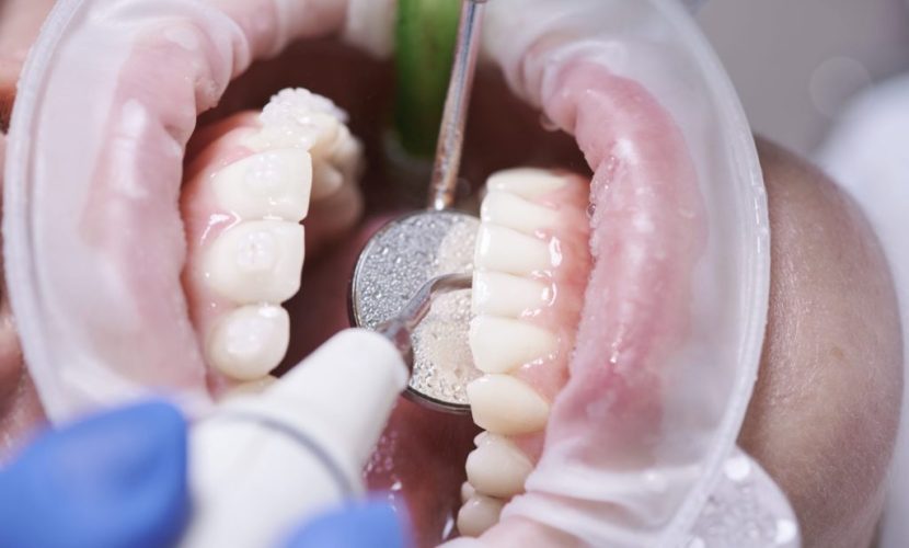 dental cleaning in spring tx